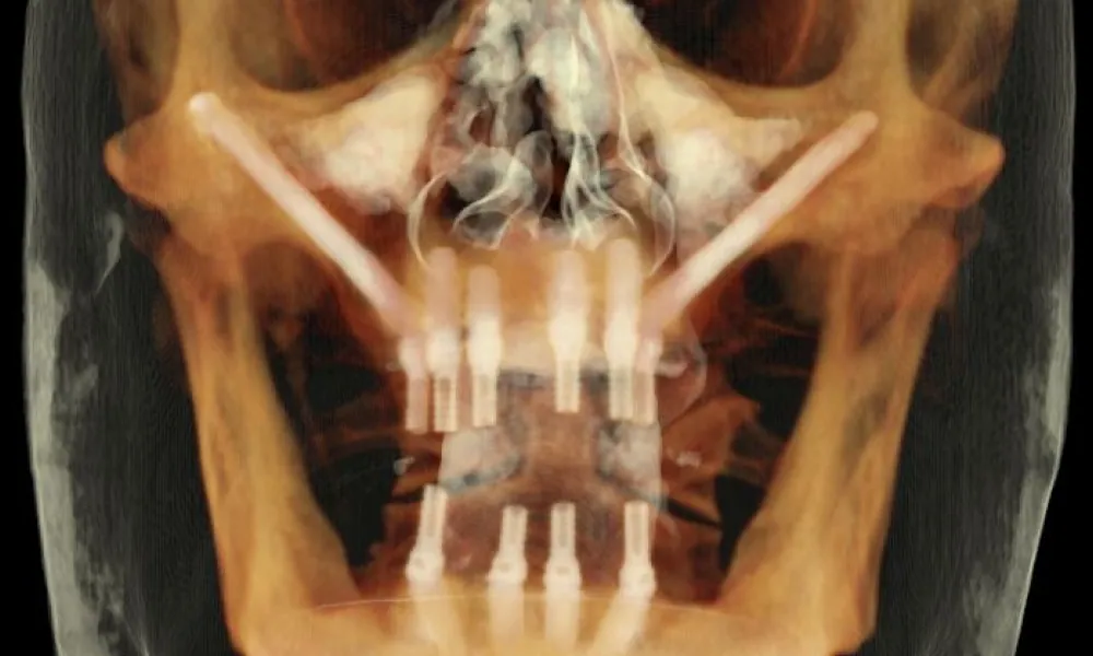 Clinical photo from Ron's dental implant case